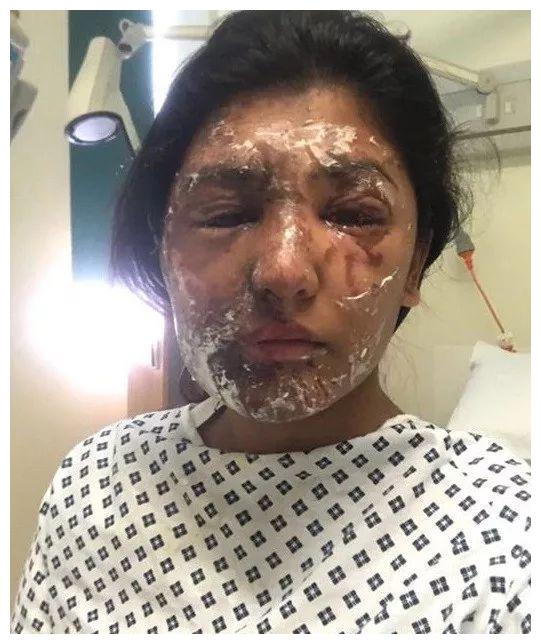 被硫酸毁容的女孩一年后面容竟奇迹般复原了