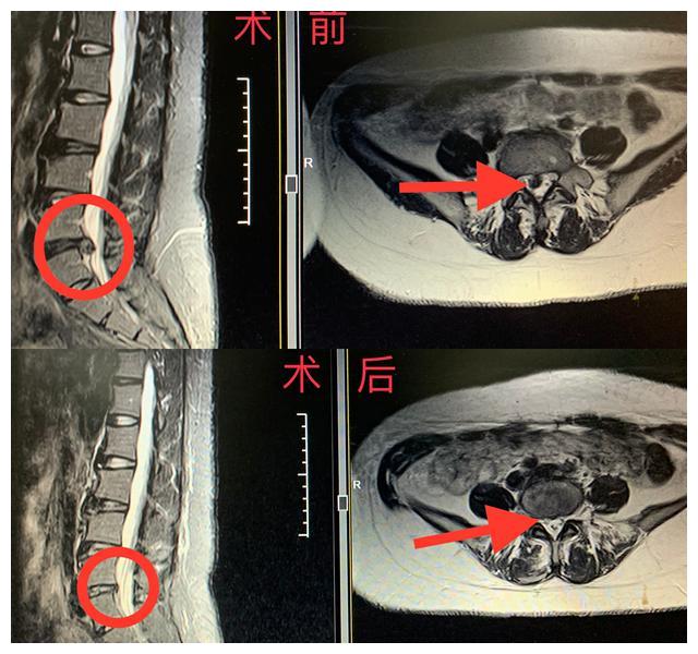 腰椎间盘突出疼痛难忍 岳阳市中医医院椎间孔镜微创术巧解顽疾