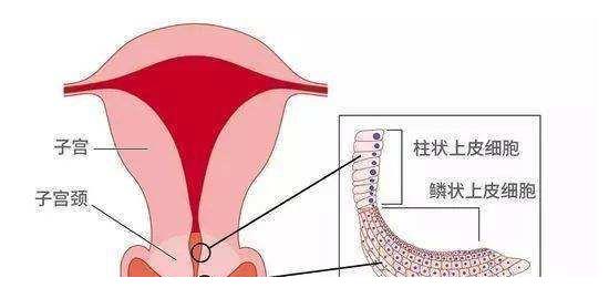 妇科检查里的"宫颈轻炎"是什么意思?是轻度宫颈炎吗?
