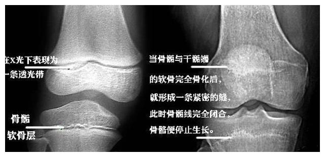 三种情况提示孩子骨骺线将闭合父母及时发现可能有机会补救