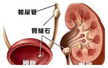 肾结石|肾脏|肾盂_新浪新闻