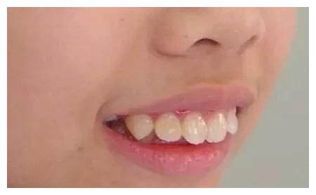 3,咬唇 经常性咬下嘴唇,可能会导致上前牙舌侧压力过大而使上前牙前突