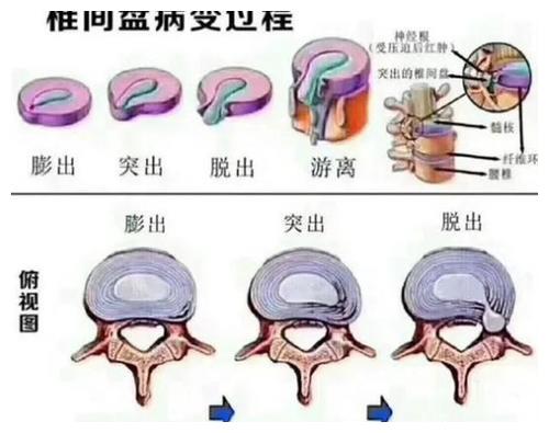 得了腰椎间盘突出一年后的感想