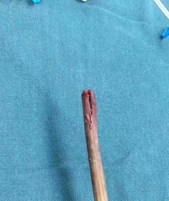 11个月男婴玩筷子时摔倒筷子从口中插入脑部