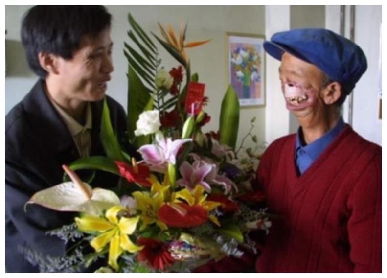 寇金成三岁时被狼咬掉半张脸靠吸米糊存活娶妻后如何生活