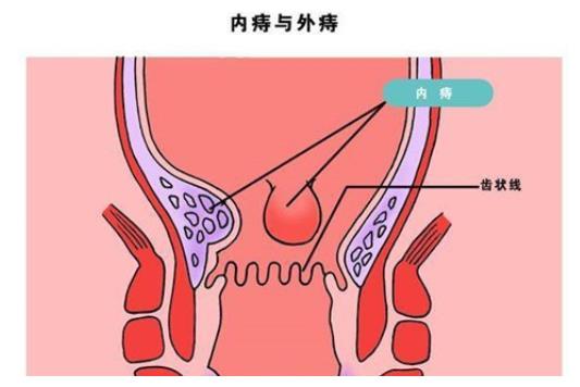 因为痔疮就诊却查出了肛周脓肿两者该如何分别