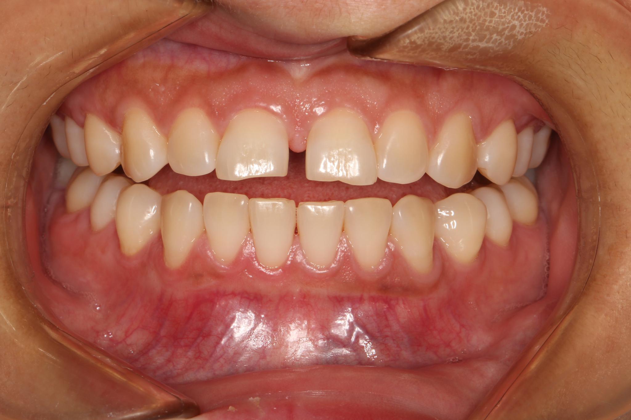 牙缝大,牙齿缺损,全瓷牙贴面帮助你改变!