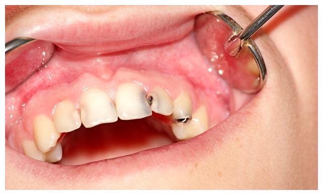 孩子蛀牙前期有三大表现,家长越早发现对孩子的牙齿更