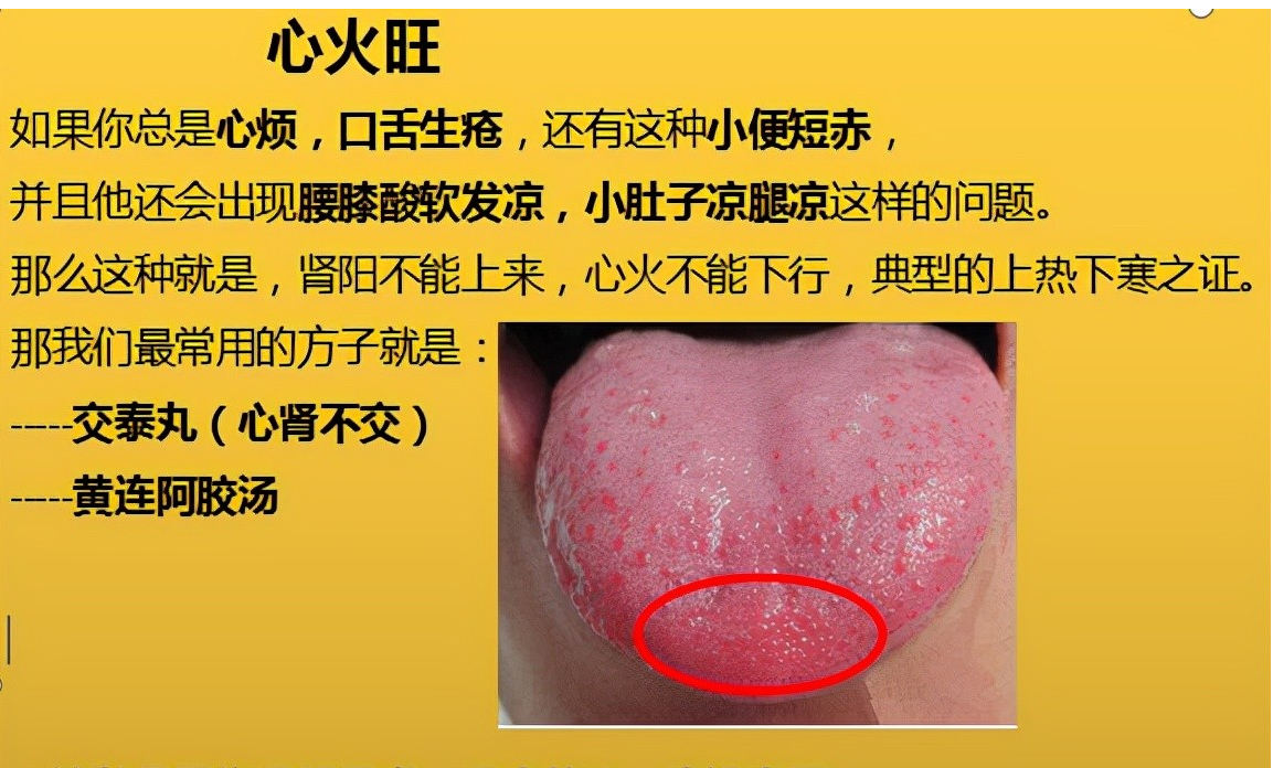 心火旺 2,肝火旺 肝火旺 3,胃火旺.