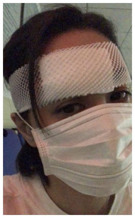 阿娇头部受伤照片曝光,下榻酒店发生意外头部撞伤达6cm缝数十针
