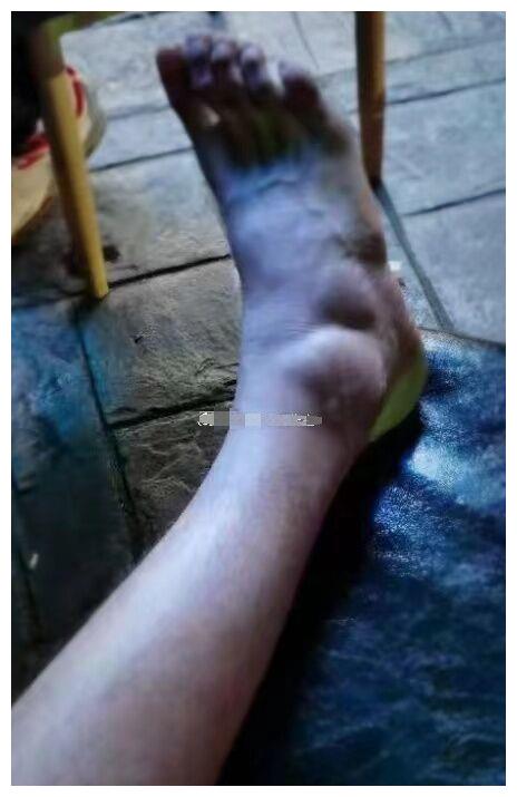 郭艾伦赛后脚踝全肿了!韩德君也是真汉子:骨折硬