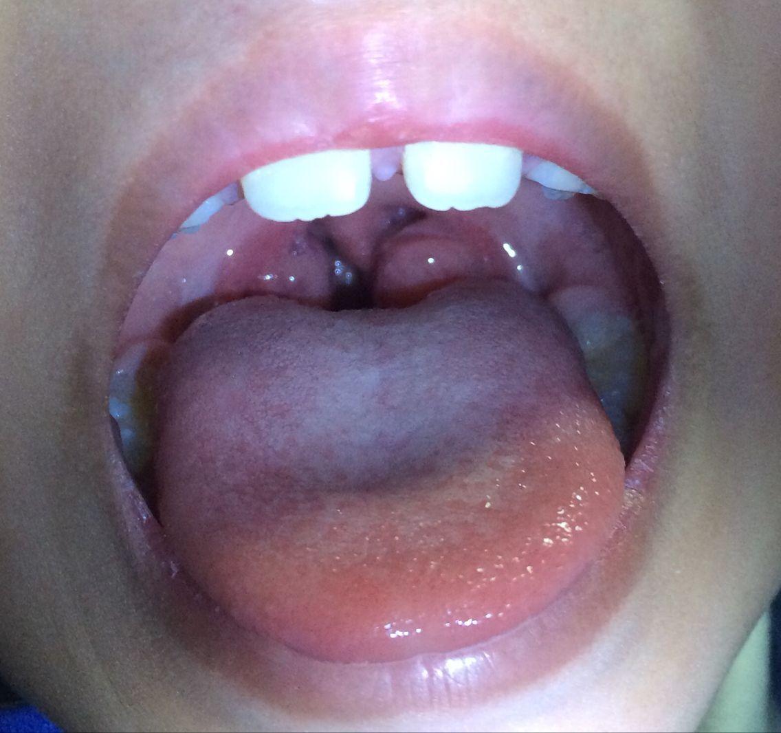 5岁小孩喉咙两边肿大是怎么