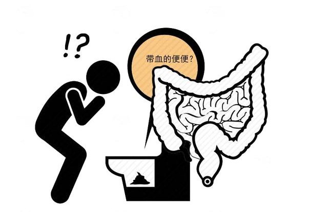 大便"先硬后软"是大肠癌征兆?医生忠告,4种异常便别掉