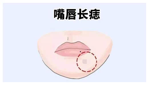 嘴唇长痣女人的嘴唇的位置处长有恶痣,则属于典型的刻薄痣,往往这样