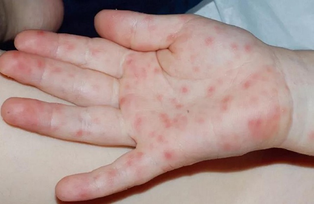 常见小儿发热出疹性疾病,有问题找医生|猩红热|皮疹