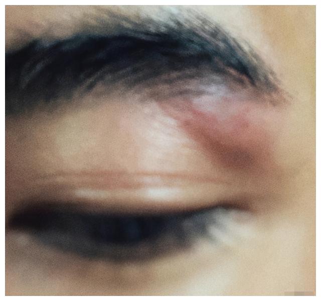 周迅玩手机躺着把鼻梁骨砸伤!于朦胧左眼超肿,周一围带伤拍戏休闲区蓝鸢梦想 - Www.slyday.coM 周迅玩手机躺着把鼻梁骨砸伤!于朦胧左眼超肿,周一围带伤拍戏休闲区蓝鸢梦想 - Www.slyday.coM