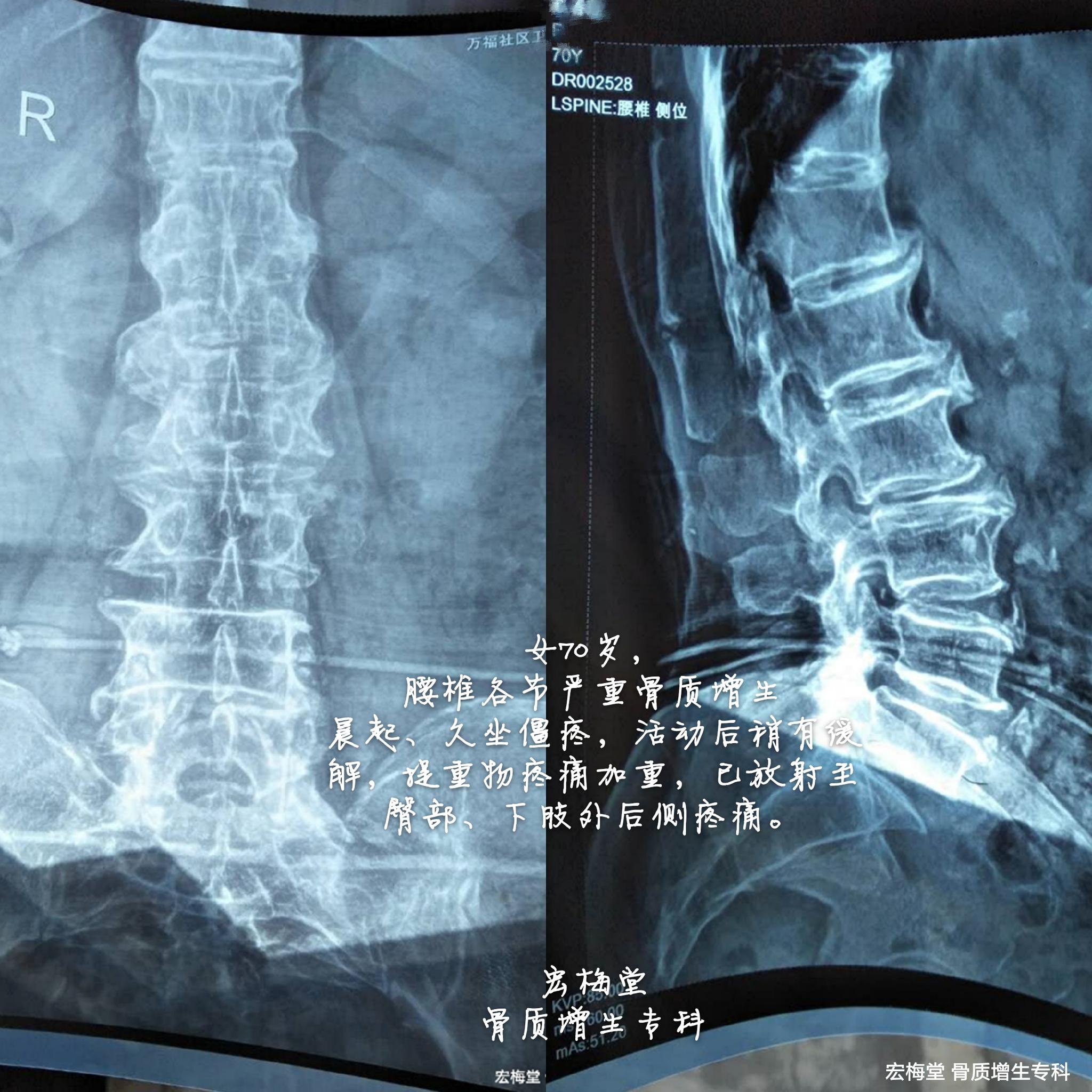 骨质增生的症状是什么,骨质增生怎么治疗