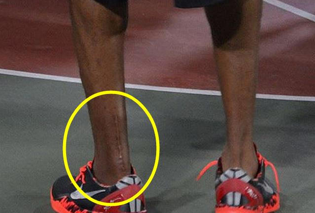 科比杜兰特等多名球员遭遇跟腱断裂,为何cba球员很少遇此伤病?