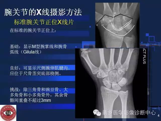 详细的腕关节x线解剖摄影技巧阅片技巧测量