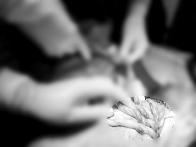 胎儿缺氧，原来是脐带绕颈5圈