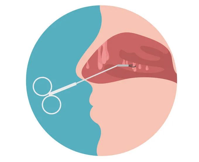 身体查出的各种“息肉”离癌到底有多远?要不要切有套判断标准!休闲区蓝鸢梦想 - Www.slyday.coM 身体查出的各种“息肉”离癌到底有多远?要不要切有套判断标准!休闲区蓝鸢梦想 - Www.slyday.coM