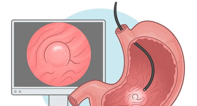 身体查出的各种“息肉”离癌到底有多远?要不要切有套判断标准!休闲区蓝鸢梦想 - Www.slyday.coM 身体查出的各种“息肉”离癌到底有多远?要不要切有套判断标准!休闲区蓝鸢梦想 - Www.slyday.coM