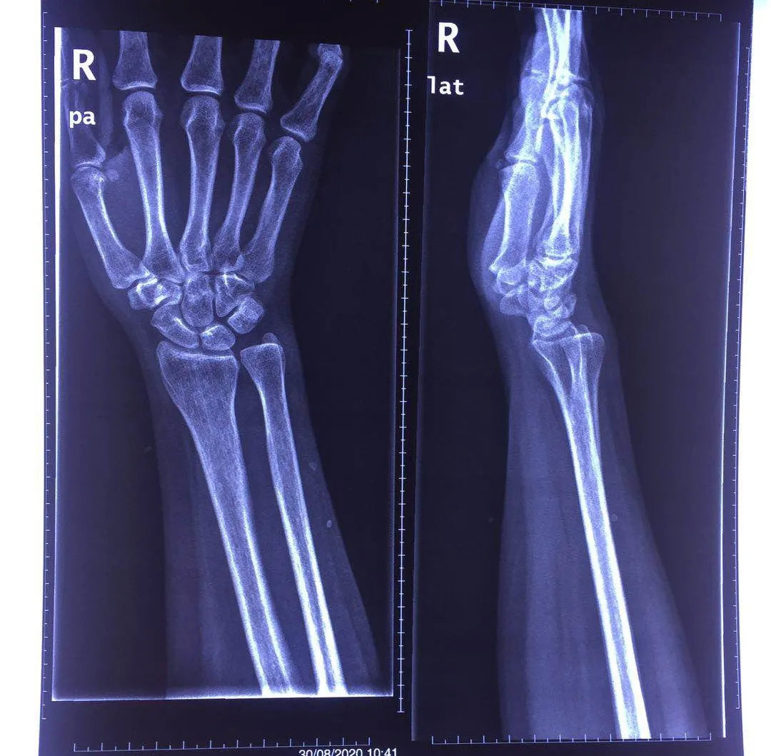 摔跤后手腕痛 当心是这种关节脱位