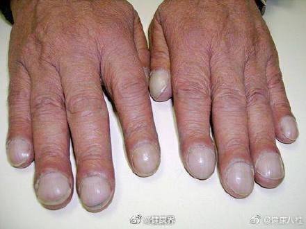 女子手指肿成萝卜头一查是肺癌休闲区蓝鸢梦想 - Www.slyday.coM 女子手指肿成萝卜头一查是肺癌休闲区蓝鸢梦想 - Www.slyday.coM