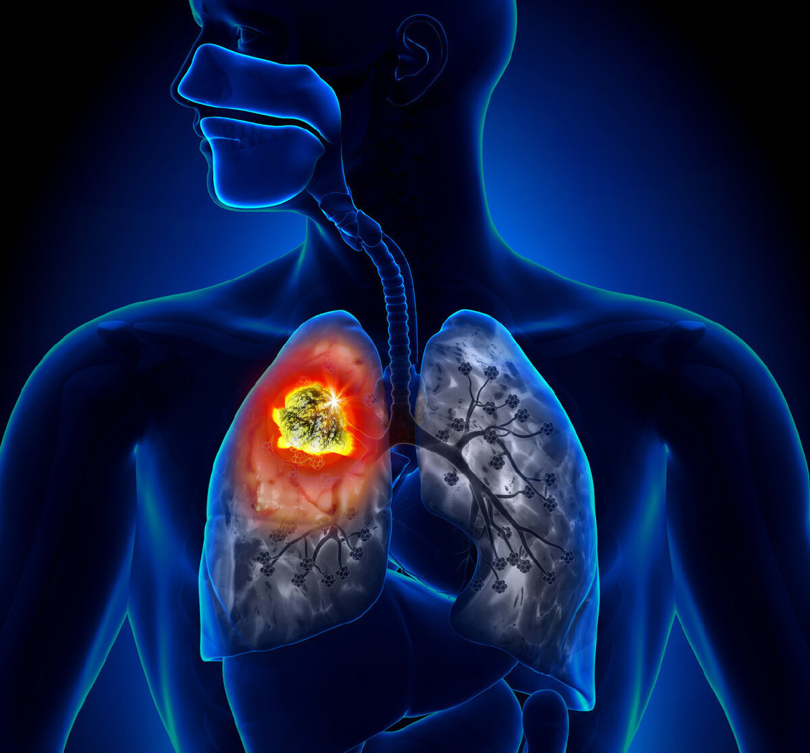 EGFR基因突变的肺腺癌抗癌成功案例-无癌家园