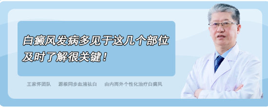 注意！白癜风发病多见于这几个部位，及时了解很关键！