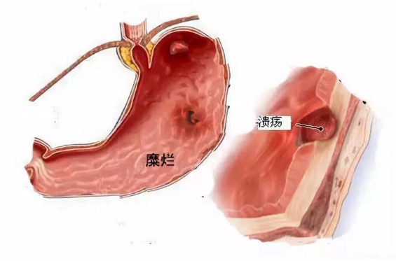 晨起有4种异常信号胃或已千疮百孔若你没有值得恭喜