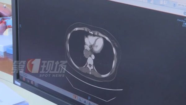 手指肿成“萝卜头”,一查竟是肺癌!警惕身体发出的这些信号休闲区蓝鸢梦想 - Www.slyday.coM 手指肿成“萝卜头”,一查竟是肺癌!警惕身体发出的这些信号休闲区蓝鸢梦想 - Www.slyday.coM