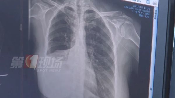 手指肿成“萝卜头”,一查竟是肺癌!警惕身体发出的这些信号休闲区蓝鸢梦想 - Www.slyday.coM 手指肿成“萝卜头”,一查竟是肺癌!警惕身体发出的这些信号休闲区蓝鸢梦想 - Www.slyday.coM