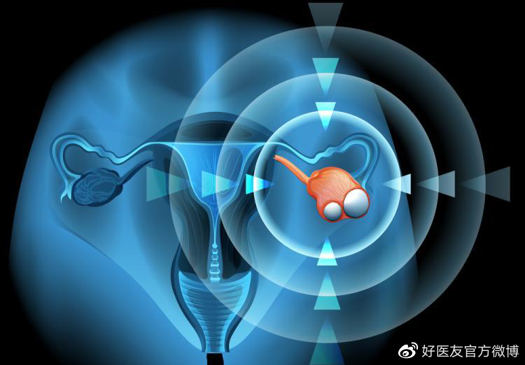 卵巢癌沉默杀手威胁 早期症状为何难发现