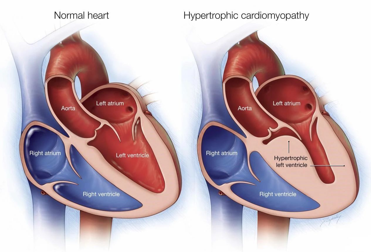 病例4-149 男性，65岁。扩张型心肌病，双侧心房扩大，右室扩大，左室壁厚度及心腔大小正常。-心血管-医学