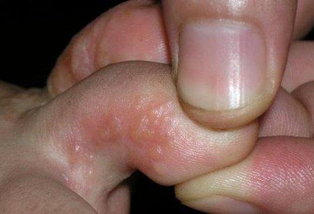 规则了;另外汗疱疹皮损多呈对称性,比如左脚有汗