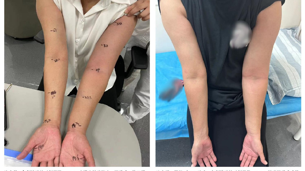 孩子的小鸡鸡突然肿起来了是怎么回事