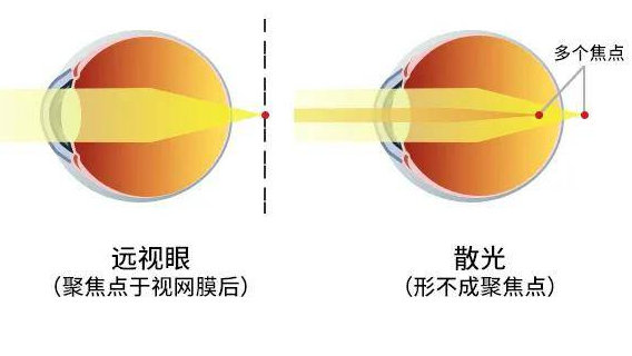 孩子50度散光需要配镜干预吗？北京希玛眼科专家表示：要视情况而定！