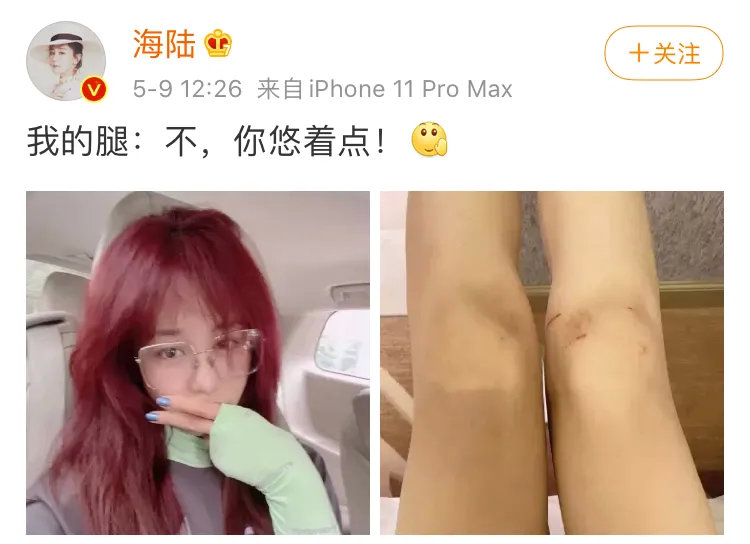 为什么一些女孩的膝盖总有淤青?