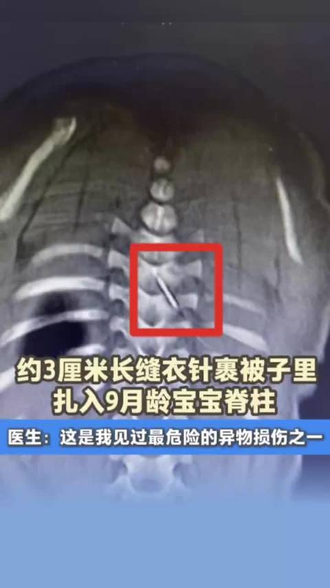 9月龄宝宝脊柱被3厘米缝衣针扎入，医生称最危险异物损伤