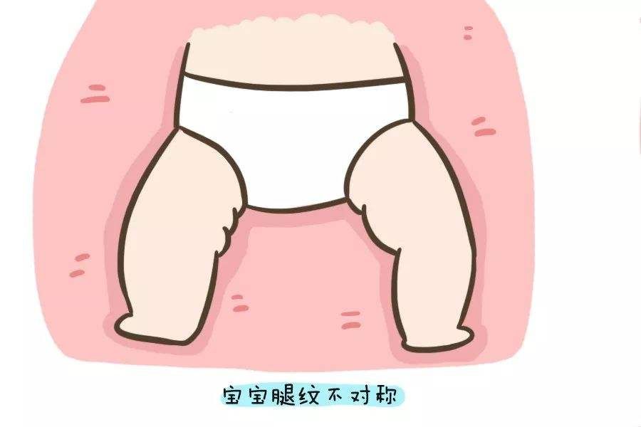 小儿推拿李波为什么宝宝臀纹腿纹不对称可能是髋关节发育不良