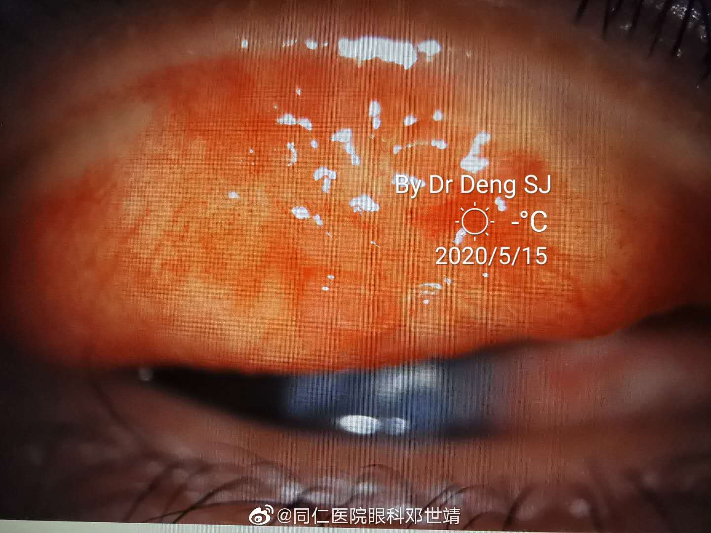 患者是一位从小受外伤失明的女性,因为眼红,分泌物多