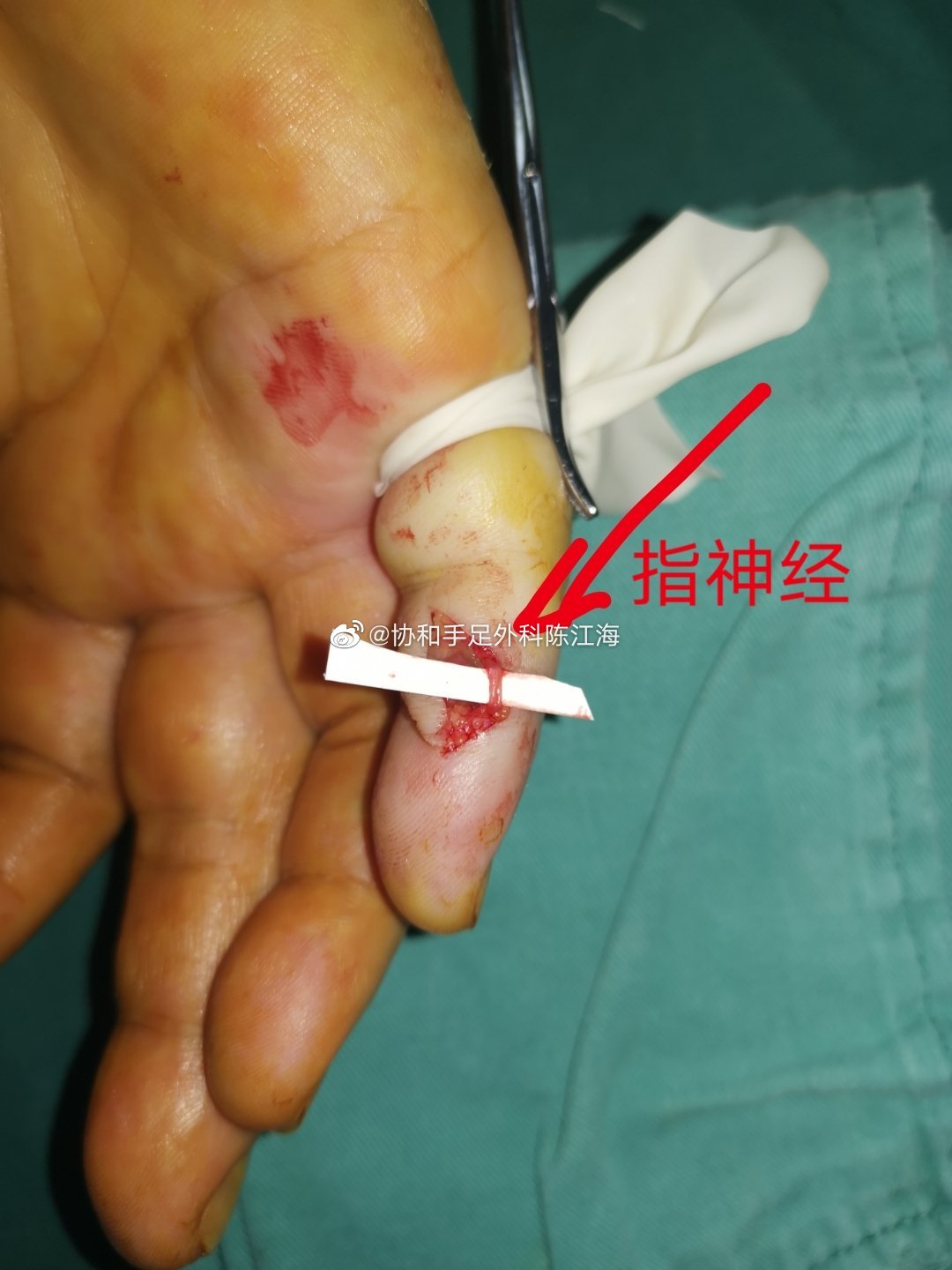 昨天做的一个小手术是切除一个腱鞘巨细胞瘤