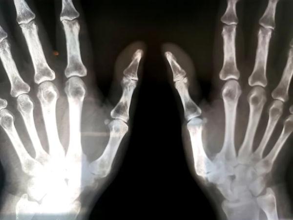 可怕!程序员手酸疼7年,一查已是骨肿瘤:骨头融成“豆腐渣”休闲区蓝鸢梦想 - Www.slyday.coM 可怕!程序员手酸疼7年,一查已是骨肿瘤:骨头融成“豆腐渣”休闲区蓝鸢梦想 - Www.slyday.coM