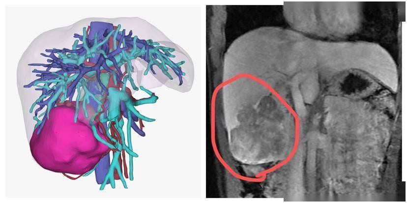 22岁女生长期熬夜+吃烧烤 查出肝癌后切掉半个肝休闲区蓝鸢梦想 - Www.slyday.coM 22岁女生长期熬夜+吃烧烤 查出肝癌后切掉半个肝休闲区蓝鸢梦想 - Www.slyday.coM