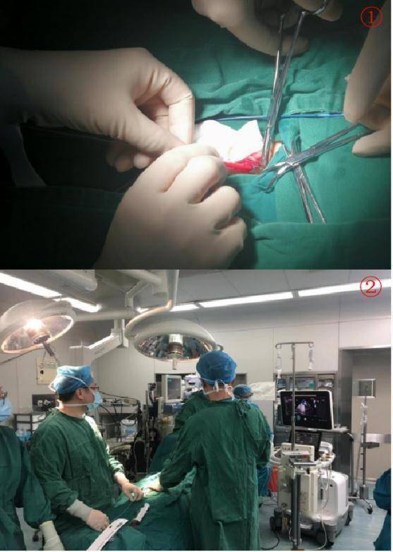 女子头痛多年,记忆力下降,元凶竟是心脏里的一个“洞”休闲区蓝鸢梦想 - Www.slyday.coM 女子头痛多年,记忆力下降,元凶竟是心脏里的一个“洞”休闲区蓝鸢梦想 - Www.slyday.coM