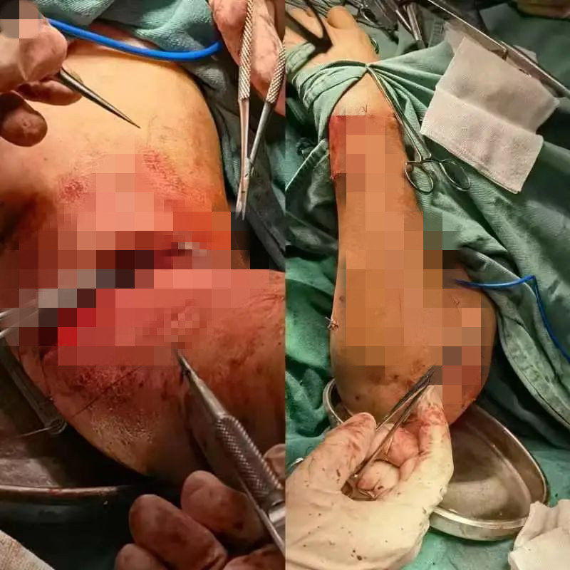 九江一女子被狗撕咬成重伤,江西省胸科医院4小时手术救治休闲区蓝鸢梦想 - Www.slyday.coM 九江一女子被狗撕咬成重伤,江西省胸科医院4小时手术救治休闲区蓝鸢梦想 - Www.slyday.coM