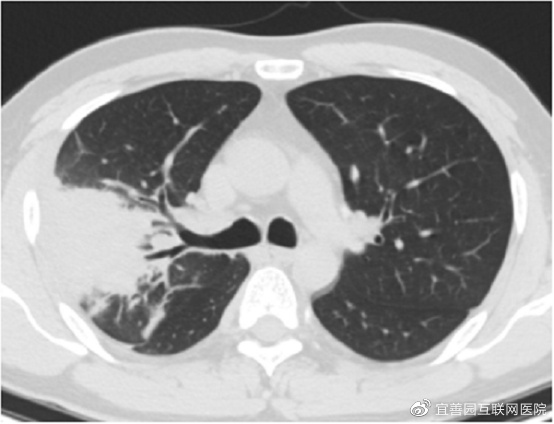 如何自查是否存在“白肺”休闲区蓝鸢梦想 - Www.slyday.coM