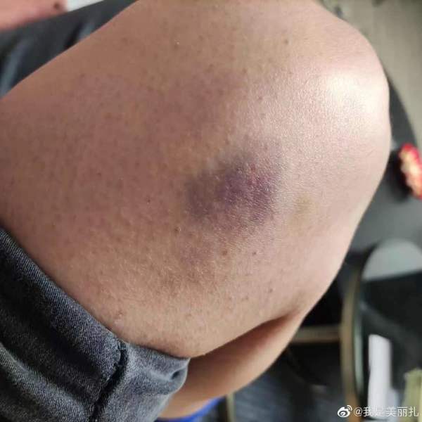 家属回应“女子爆料遭球员殴打”:球员曾愿道歉后反悔 自称不便公开道歉休闲区蓝鸢梦想 - Www.slyday.coM 家属回应“女子爆料遭球员殴打”:球员曾愿道歉后反悔 自称不便公开道歉休闲区蓝鸢梦想 - Www.slyday.coM