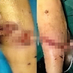 九江一女子被狗撕咬成重伤,江西省胸科医院4小时手术救治休闲区蓝鸢梦想 - Www.slyday.coM 九江一女子被狗撕咬成重伤,江西省胸科医院4小时手术救治休闲区蓝鸢梦想 - Www.slyday.coM